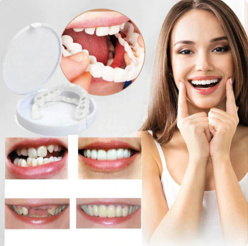 SOURIRE PARFAIT - FACETTES DENTAIRES INFÉRIEURES ET SUPÉRIEURES