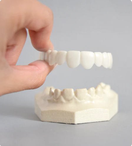 SOURIRE PARFAIT - FACETTES DENTAIRES INFÉRIEURES ET SUPÉRIEURES