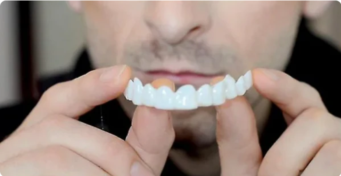 SOURIRE PARFAIT - FACETTES DENTAIRES INFÉRIEURES ET SUPÉRIEURES