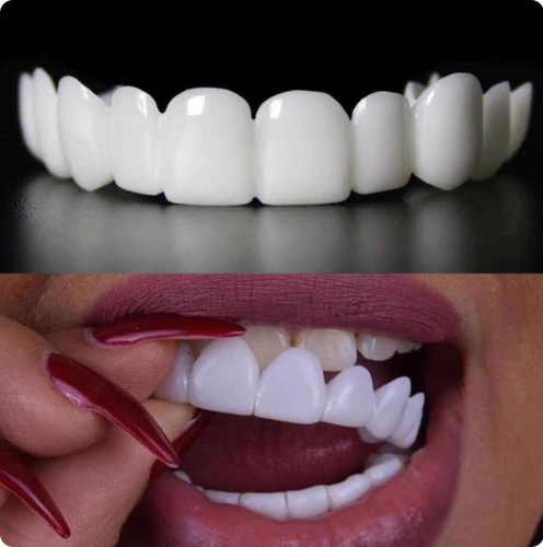 SOURIRE PARFAIT - FACETTES DENTAIRES INFÉRIEURES ET SUPÉRIEURES